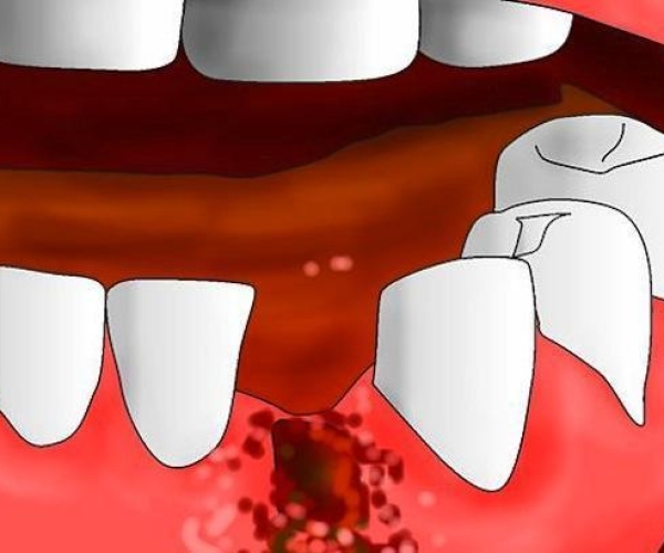 拔牙一直流血怎么办 拔牙出血不止怎么办？